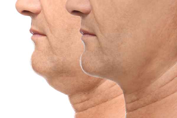 HIFU - Breakthrough in Anti - ageing 2 hifu results Wentworth
