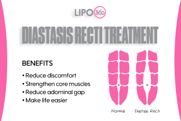 Revolutionising Muscle Repair: The Power of LIPO360 Body Sculpt Post-Injury 5 diastasis recti treatment Wentworth