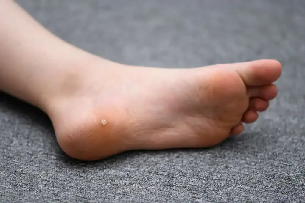 Cryotherapy For Warts And Also Verrucas 2 Image of verruca on the bottom of the foot that able to be treated with Cryotherapy Wentworth