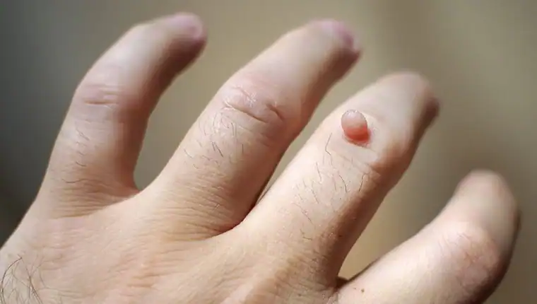 Image of blemish that Cryotherapy Wentworth can remove with Lipo 360.