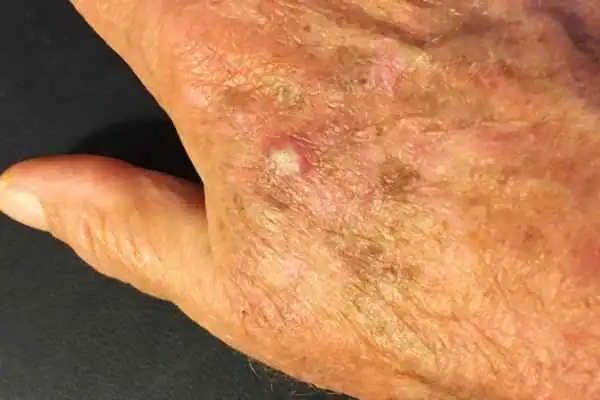 Image of Actinic keratoses Wentworth on a person hand