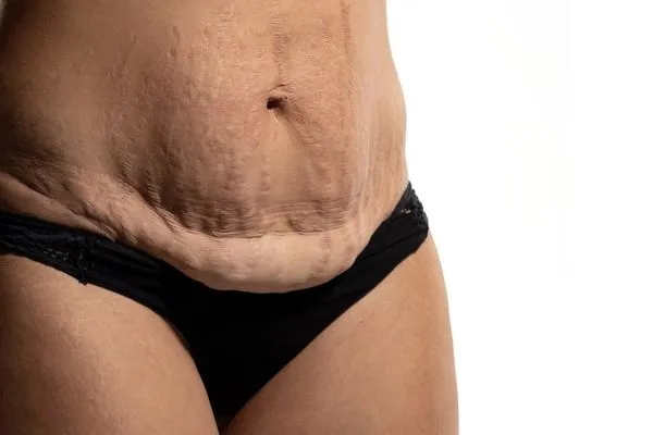 The science behind skin tightening Wentworth picture of a woman's sagging skin on the stomach